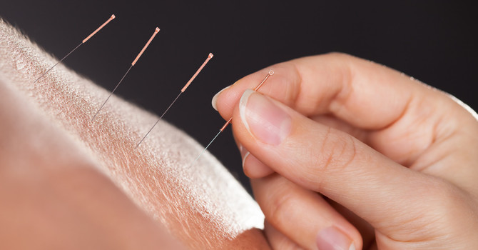 Acupuncture